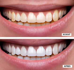 hismile-avis-dentiste-resultat-blanchiment-avant-apres