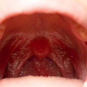 Palais gonflé derrière les dents du haut : Symptômes et Causes